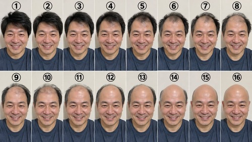 【画像】薄毛は「何番」からなのか、議論が分かれてしまうｗｗｗｗｗ