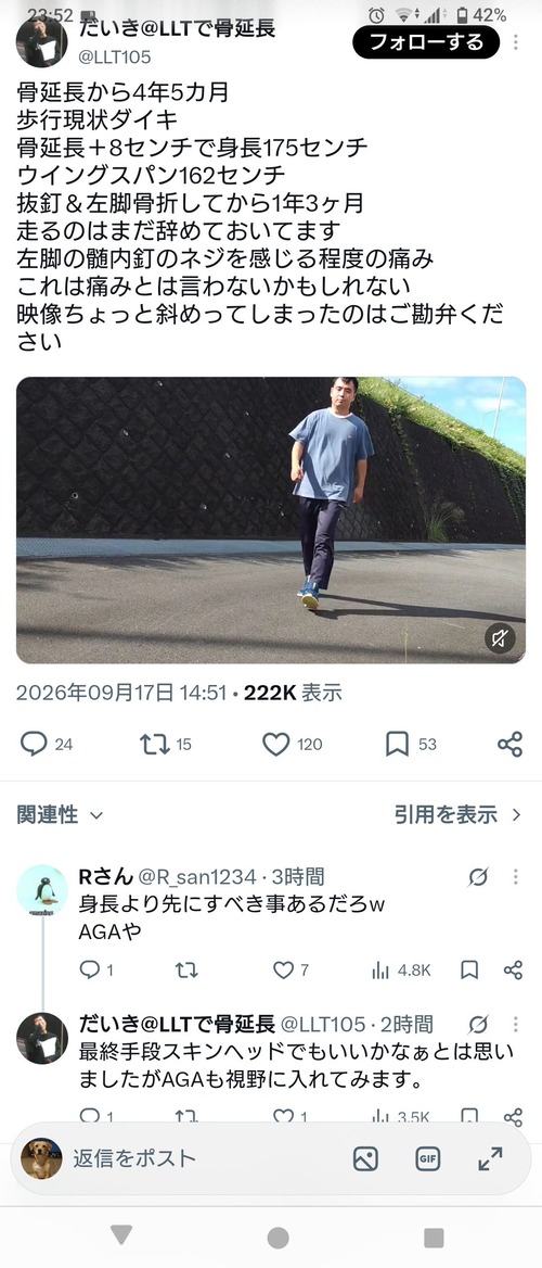 【画像】骨延長で175センチの身長を手に入れた男性、現状を報告するｗｗｗｗｗ