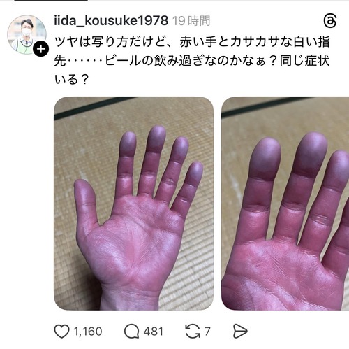 【悲報】ビール好きおじさん、手の色がエゲつないことになってしまうｗｗｗｗ