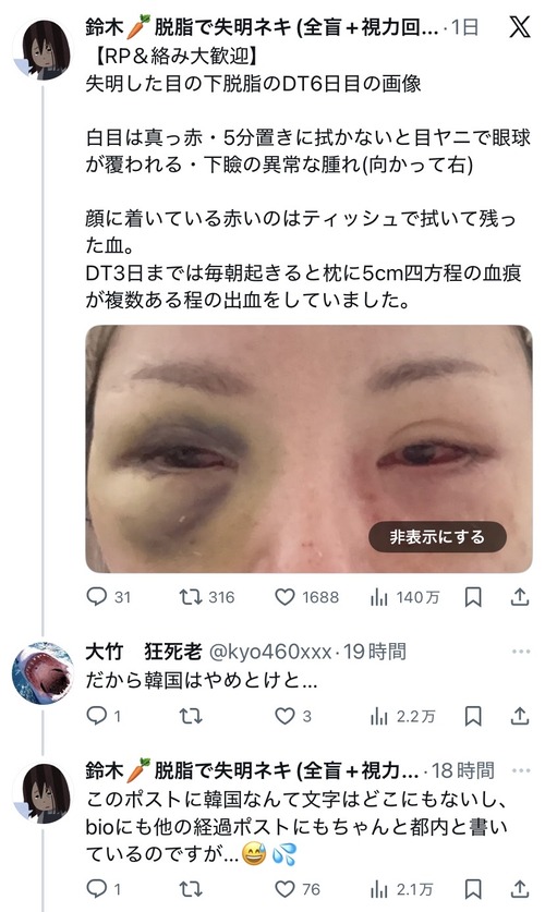 【画像】目のクマ取り手術をした女性、片目を失明してしまう…