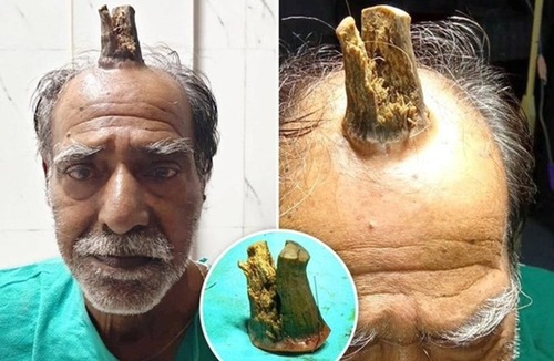 【画像】頭をぶつけたジイさん、なんと頭から「謎の木」が生えてきてしまうｗｗｗｗ