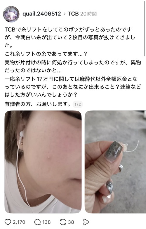 【画像】整形女子「顔から白い糸が出てきて抜けた」←怖すぎると話題にｗｗｗｗｗ