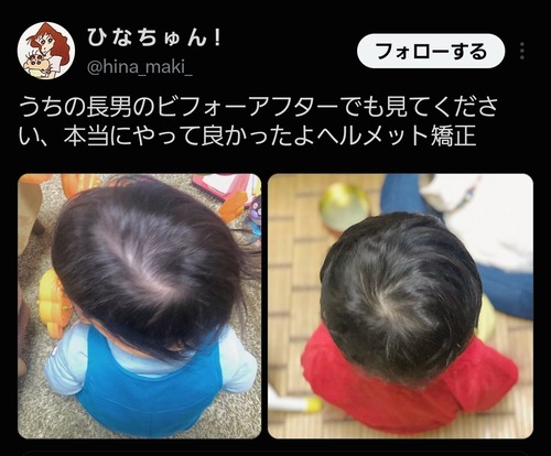 【画像】ヘルメット矯正をやったキッズの末路ｗｗｗｗｗｗ