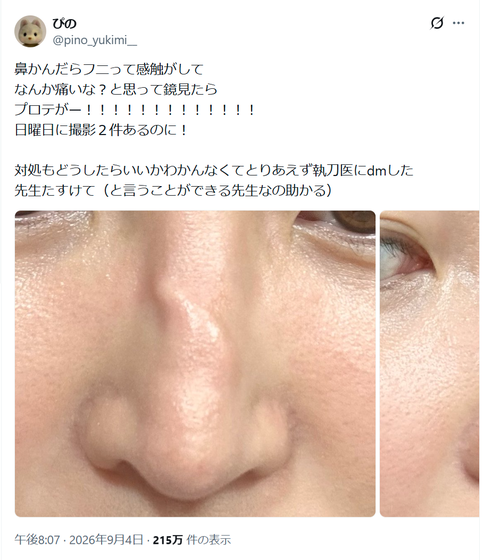 【画像】整形女子、鼻をかんでとんでもない事になってしまうｗｗｗｗ