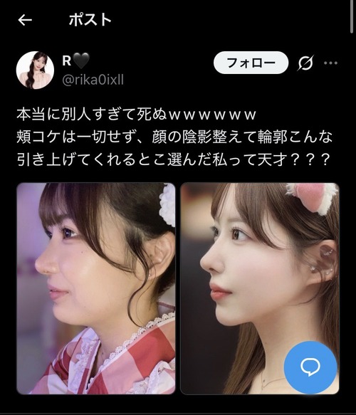 【画像】美女「顔の脂肪吸引して垢抜けた～！」(ﾊﾟｼｬｯ