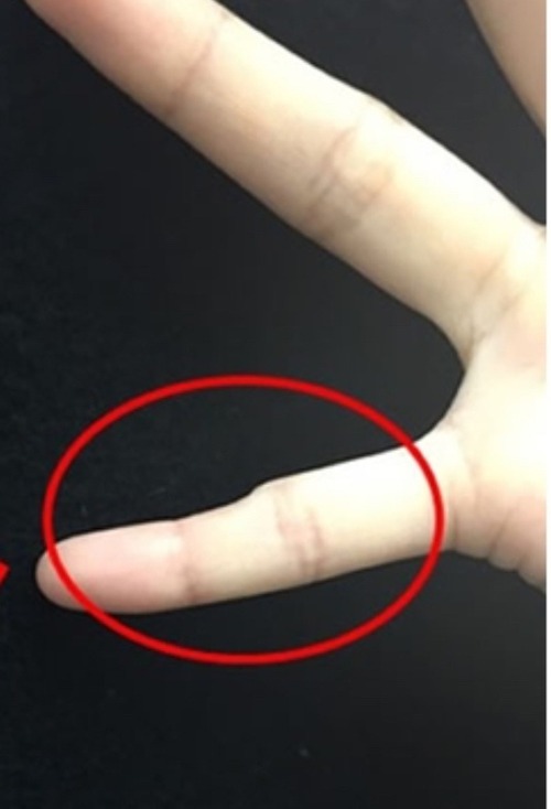 【画像】スマホを「小指」で支えている人、小指が変形してこうなるらしいｗｗｗｗ