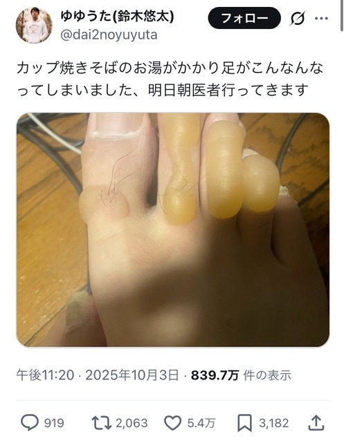 【悲報】人気配信者「カップ焼きそばのお湯、足にこぼした…」→とんでもない火傷にｗｗｗｗｗ