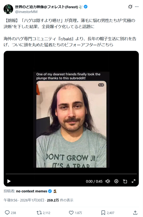 【朗報】ハゲ男性、たったコレだけでイケメンになれることが判明するｗｗｗｗ