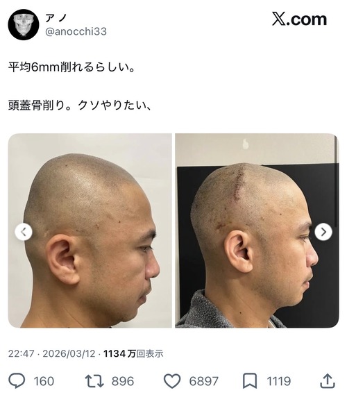 【画像】美容整形界隈、「頭蓋骨削り」が流行り始めるｗｗｗｗｗ