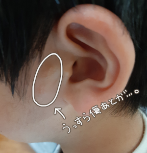 副耳3