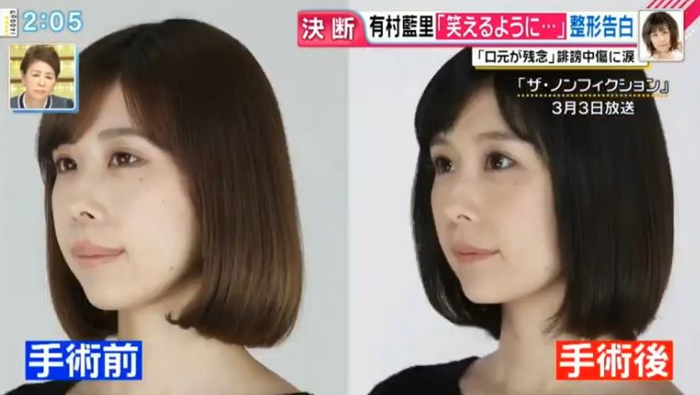 メンヘラ 有村藍里 整形後にメンタルやられてる模様wwwwwwwwww アイドル整形 美容まとめ