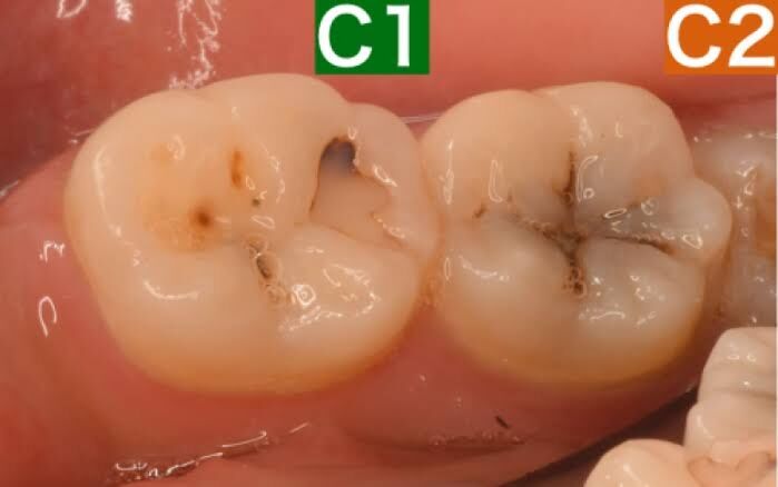 麻酔無し】C1の虫歯を治療してきた話【痛み】 : ダメリーマンのだらり旅