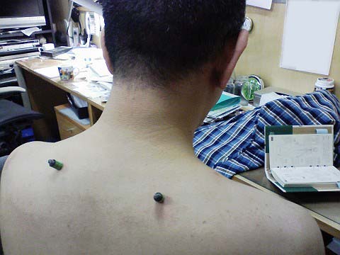 なをさんに灸をすえる からまんブログ