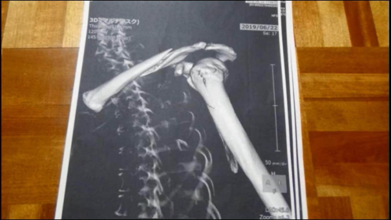 悲報 Aiueo700岩間好一さん ガチのマジで満身創痍だった レントゲン写真をアップする 大物youtuber速報