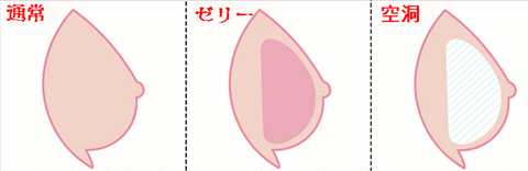 ゼリー胸