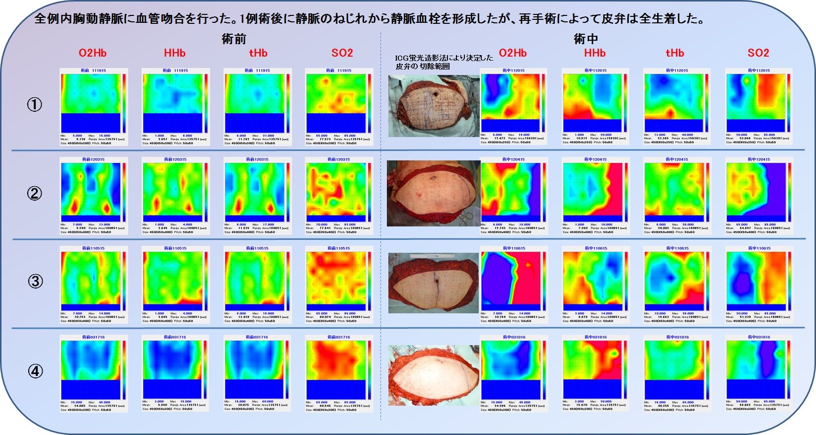 光マンモグラフィー:乳がん機能イメージングの臨床応用