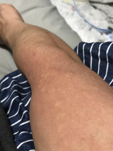 【恐怖】腕にﾎﾞﾂﾎﾞﾂがめちゃくちゃあるのだがこれってダニに噛まれたのか？ｗｗｗｗｗｗｗｗｗｗｗｗｗｗｗｗｗ