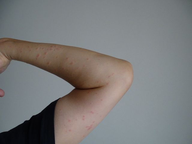 腕に湿疹がぁ Oh 楽しんセサイザー 腕に湿疹がぁ Oh 楽しんセサイザー