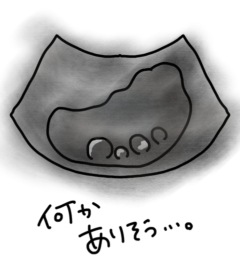 胆石3