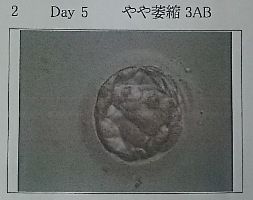 15 5日目胚盤胞