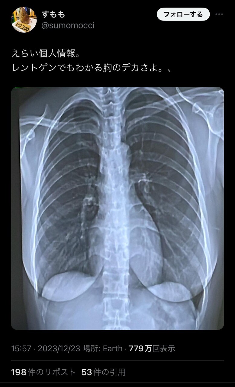 レントゲン エロ