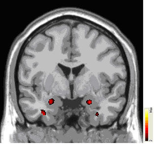 脳構造の違いにあった 右寄りの考え方をする人は恐怖をつかさどる 扁桃体 が発達している 英研究 ザイーガ 脳構造の違いにあった 右寄りの考え方をする人は恐怖をつかさどる 扁桃体 が発達している 英研究 ザイーガ