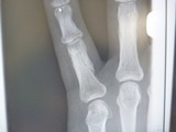 骨折3ヶ月目の小指