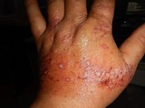 右手の蕁麻疹発症から4週間経過