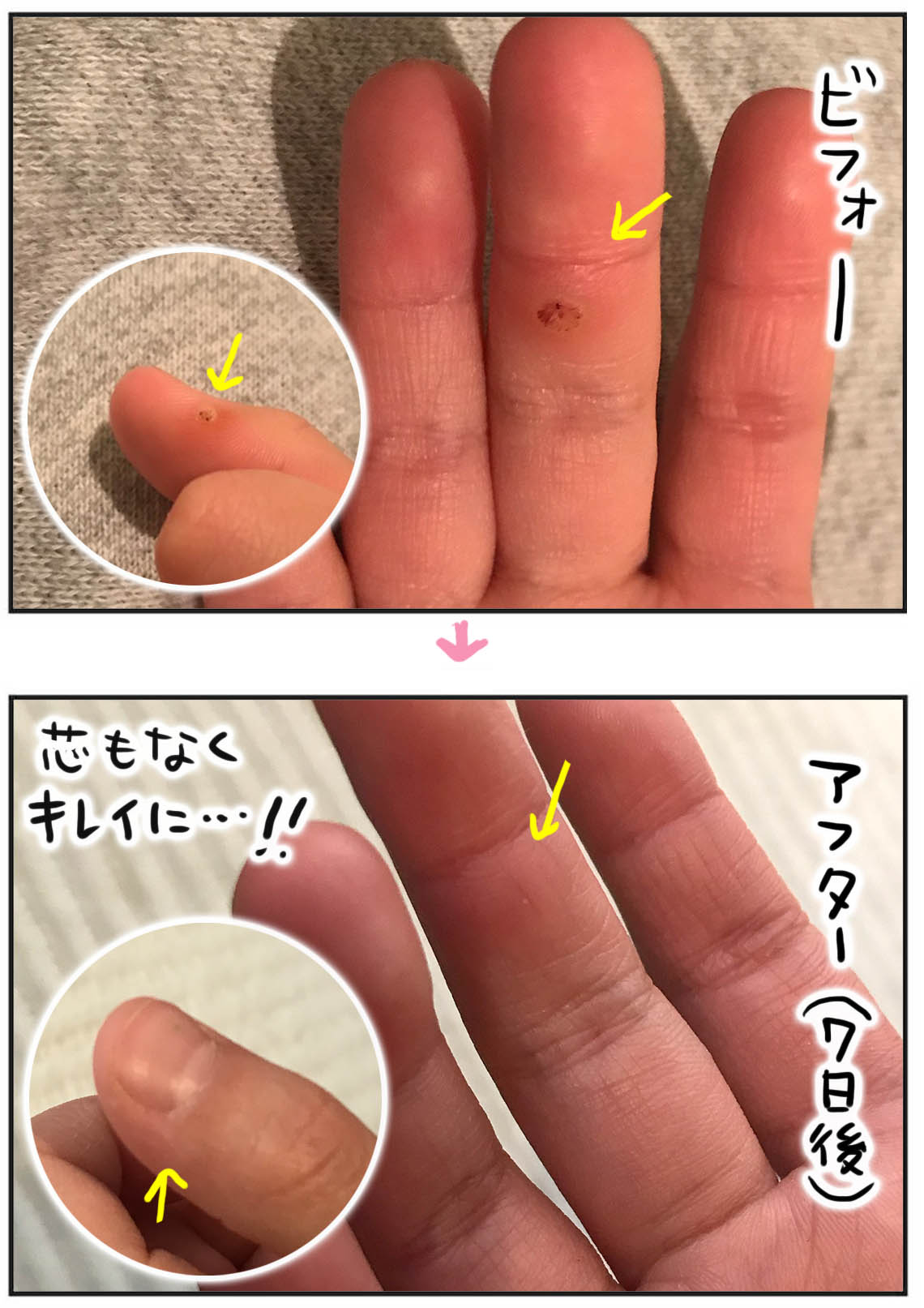 厄介なイボ うちの子はこれで治ったレポ 後編 たまご絵日記 2児のかあちゃん奮闘記 Powered By ライブドアブログ 厄介なイボ うちの子はこれで治ったレポ 後編 たまご絵日記 2児のかあちゃん奮闘記 Powered By ライブドアブログ