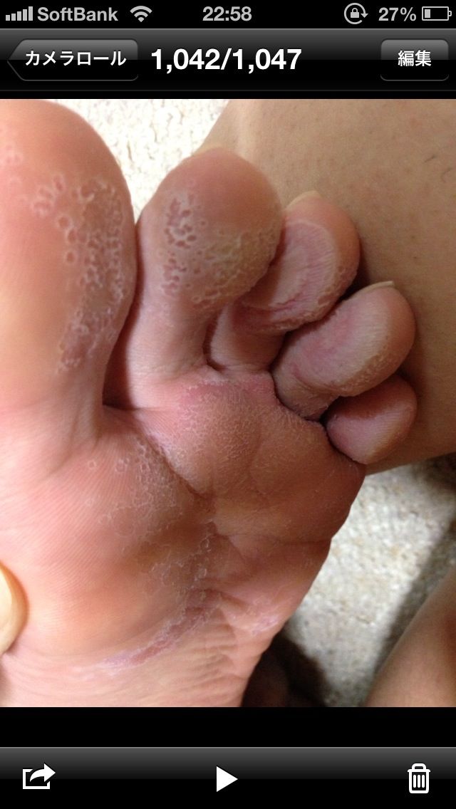 マラニック速報 画像 足の裏きめぇwwwwwwwww