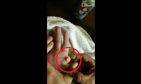 Video Of Men Popping Their Friend s Cyst