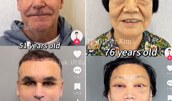 若返り手術で患者をジョーカーのようにしてしまう美容整形医師が炎上しているようです！（２つのビデオ）