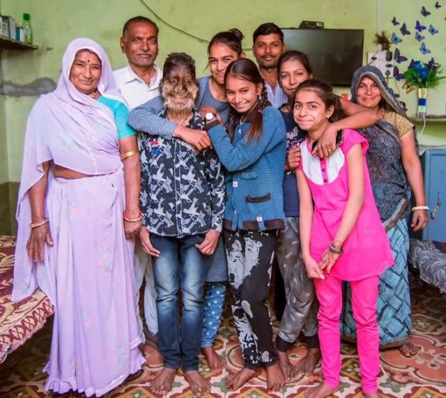 インドの顔が毛で覆われているために オオカミ少年 と呼ばれている13歳の男の子 8枚の写真とビデオ 夜ふかしのすすめ