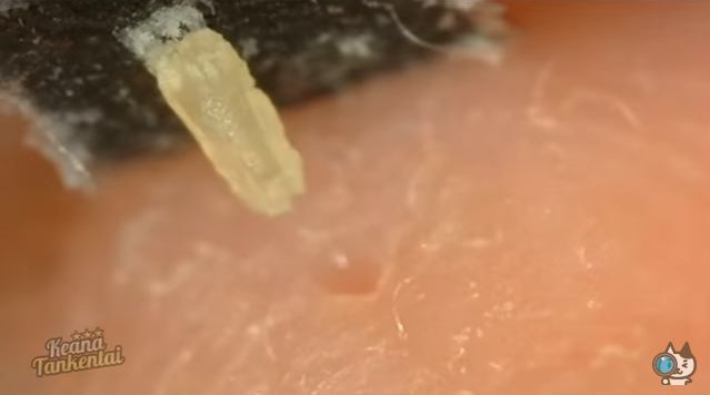 毛穴パックで鼻の角栓がスポスポ抜けていく拡大映像が海外で話題にｗ 夜ふかしのすすめ