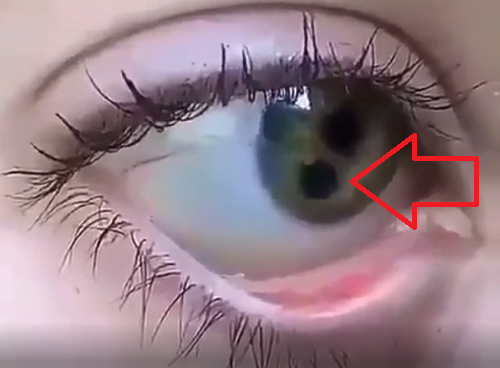 一つの目に二つの瞳孔が存在する稀な状態の人がいる！