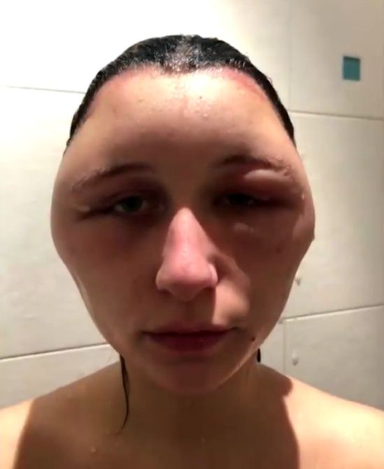 allergy_hair_dye_06
