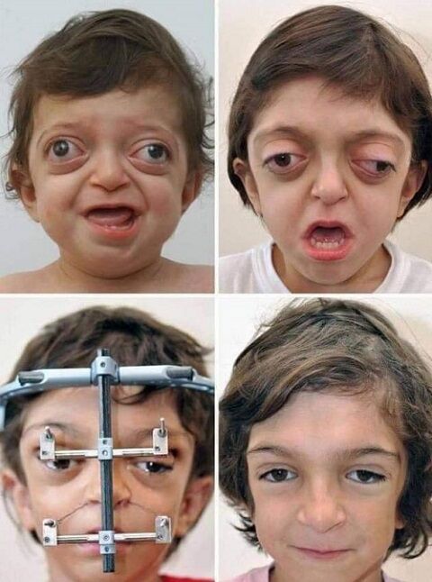 クルーゾン症候群の子供に美容矯正が行われた結果が凄い 5枚の写真 夜ふかしのすすめ