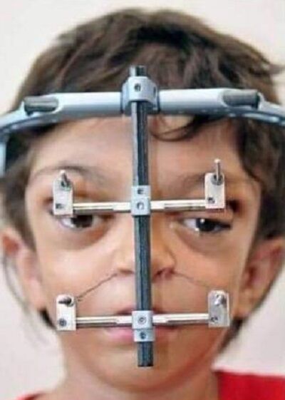 クルーゾン症候群の子供に美容矯正が行われた結果が凄い 5枚の写真 夜ふかしのすすめ