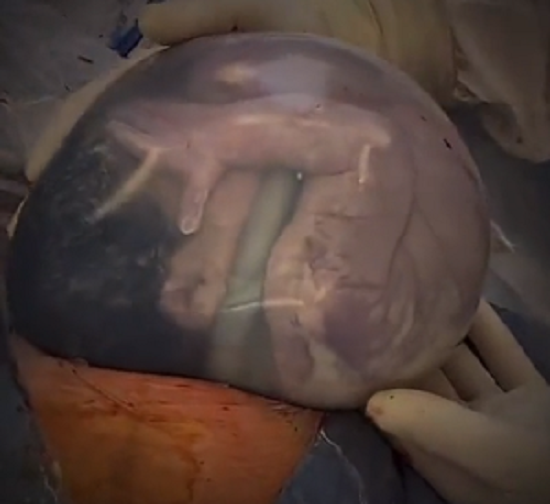 羊膜に包まれたまま産まれた赤ちゃんの羊膜を切り開いた本当の誕生の瞬間が凄い！（3つのビデオ）