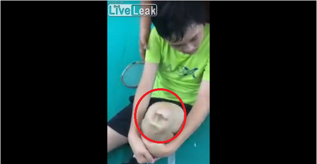 サッカーの試合中に膝を蹴られたらしいのだが どうなってるんだこれ 夜ふかしのすすめ