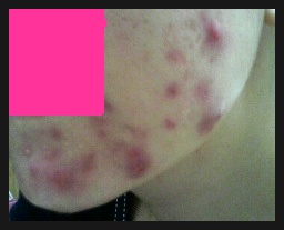 Nikibikki ニキビの観察 Livedoor Blog ブログ