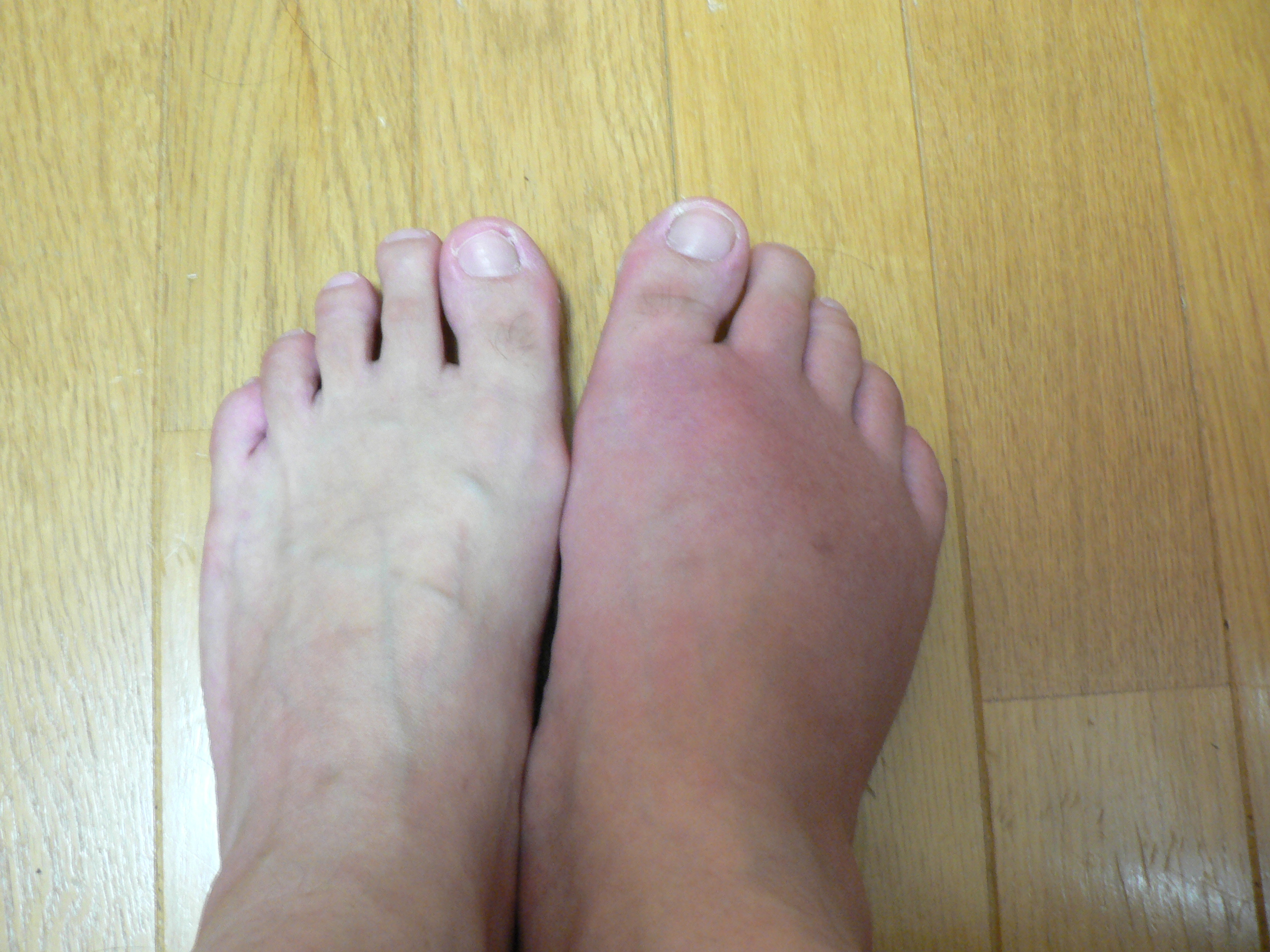 痛風の症状の写真 腎臓病 慢性腎炎 Iga腎症 と診断された方へ 痛風の症状の写真 腎臓病 慢性腎炎 Iga腎症 と診断された方へ