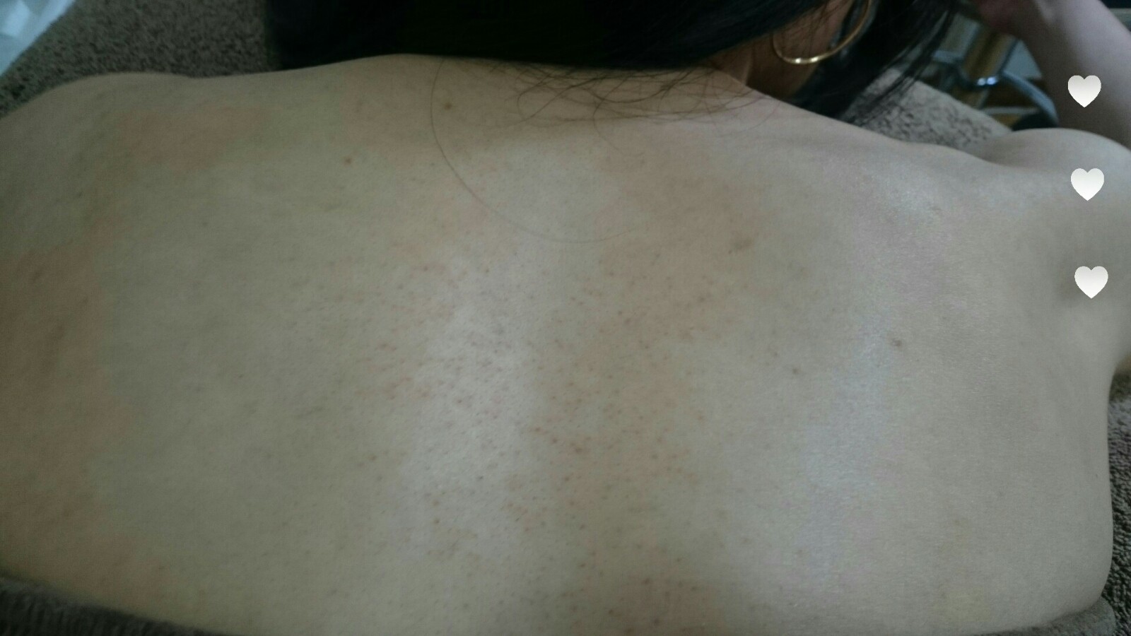 背中のプツプツ ボディの悩みに 長崎グリーンピール認定サロン フランカパピ 080 56 0512