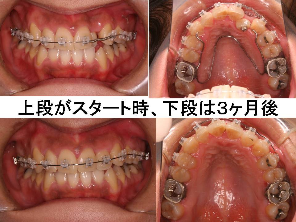 当院の歯列矯正モニターシステムとは プロ先生の歯列矯正日記