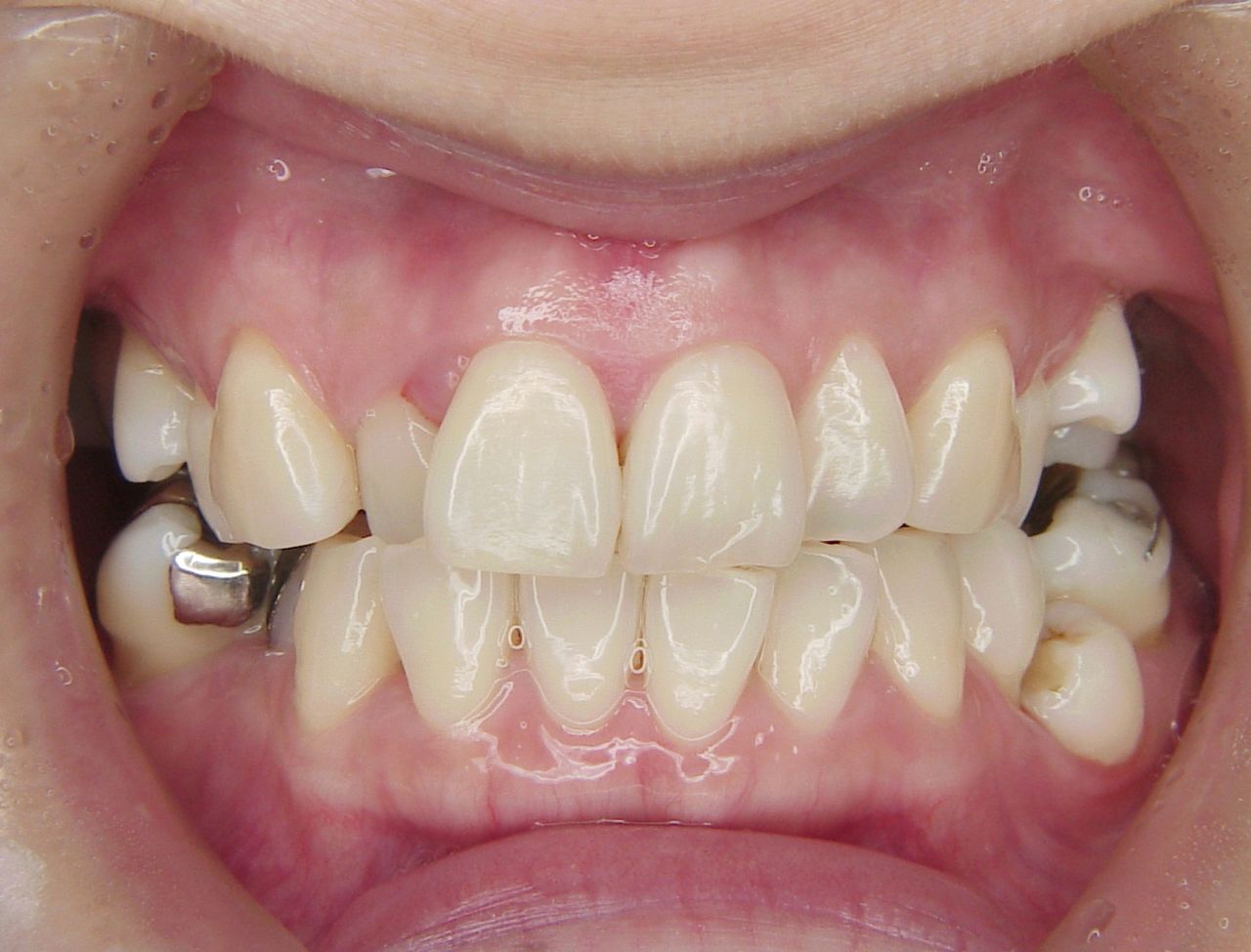 ３０代をすぎると歯周病を考慮した歯列矯正治療が必要になる プロ先生の歯列矯正日記