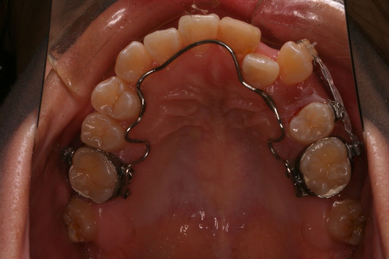 親知らずの歯を利用する治療方法もあります プロ先生の歯列矯正日記