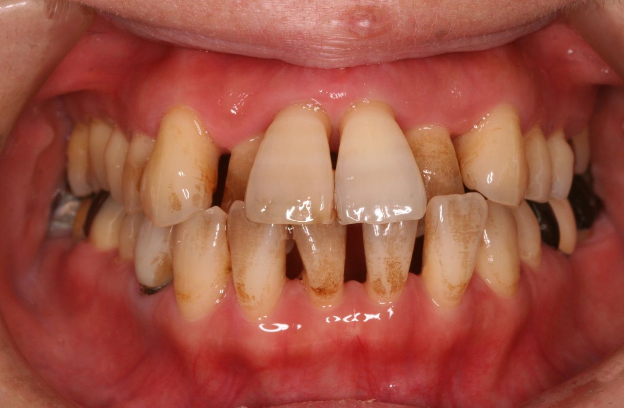 歯周病患者の歯科矯正治療１ プロ先生の歯列矯正日記