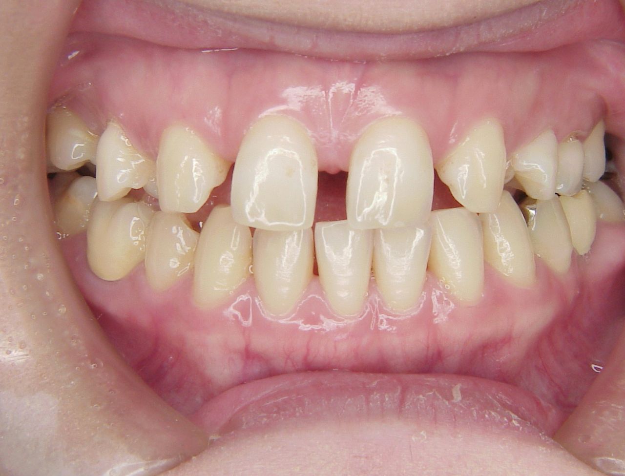 永久歯が少なく大人になっても乳歯が残っている場合の対応 後半 プロ先生の歯列矯正日記