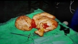 グロ注意 歳の女性の体内から妊娠40年目で石化した胎児が発見される 速報 Vipper World