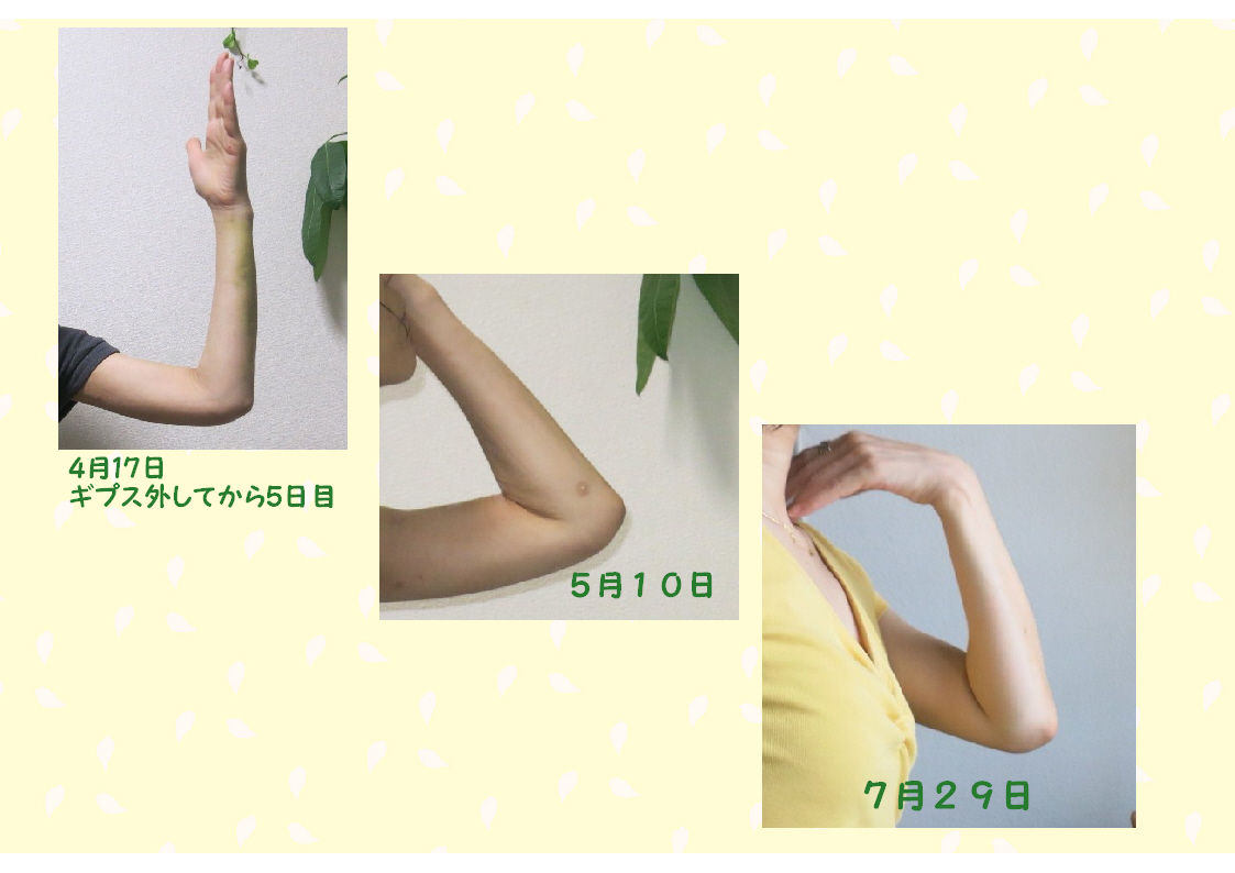 骨折から3か月半 ここまで治った2 肘骨折治療 Keep Looking Up That S The Secret Of Life 骨折から3か月半 ここまで治った2 肘骨折治療 Keep Looking Up That S The Secret Of Life